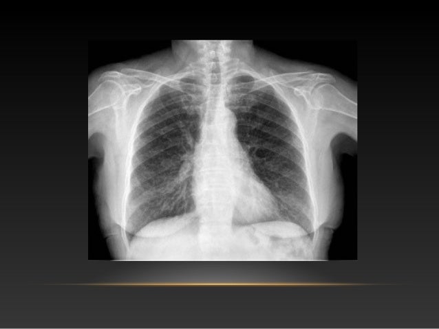 histiocitosis x pulmonar